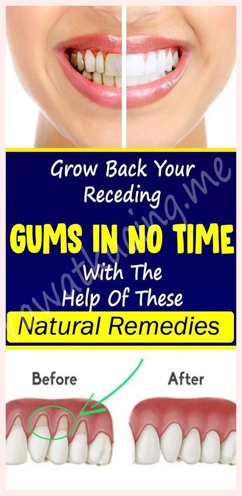 Grow Back Your Receding Gums With The Help Of These Natural Remedies Mm Recipes, Breastfeeding Nutrition, Holistic Health Nutrition, Nutrition Infographic, Gum Recession, Healthy Facts, Health Articles Wellness, Integrative Nutrition, Bathing Beauty