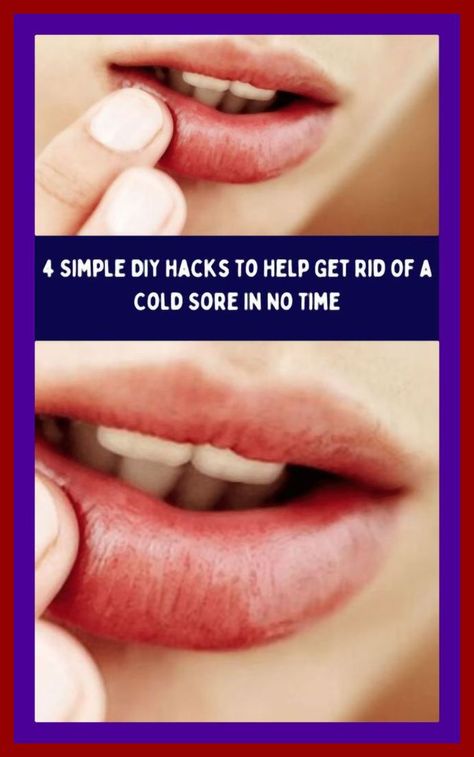 Get Rid of Herpes By Using a Simple Trick Fast Cold Sore Remedy, How To Heal A Cold Sore Fast, How To Treat Cold Sores Fast, Lysine For Cold Sores, Home Remedy For Cold Sore On Lip, How To Stop A Cold Sore Before It Starts, How To Get Rid Of A Cold Sore Fast, How To Get Rid Of Cold Sores, How To Get Rid Of Cold Sores Overnight