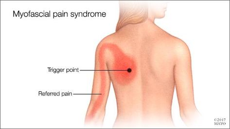 Myofascial Pain Syndrome, Neck And Shoulder Exercises, Referred Pain, Chronic Pain Management, Nerve Health, Chronic Pain Relief, Shoulder Pain Relief, Q And A, Myofascial Release