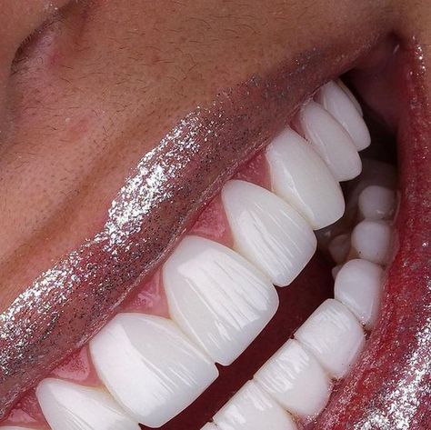 Nice Smile Teeth, Perfect Teeth Smile, Teeth Veneers, Losing Teeth, Cosmetic Dentistry Procedures, New Teeth, Pretty Teeth, Getting Braces, Veneers Teeth