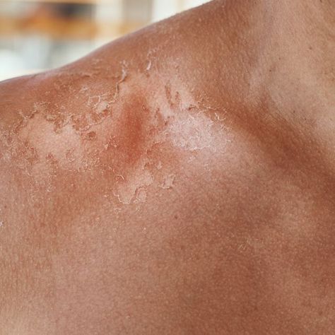 Sunburn on the shoulders of men. Shoulders with a hurt skin fron sun burn, closeup Burns On Skin, Sunburn Aesthetic, Best Sunburn Relief, Sunburn Lotion, Sunburn Face, Beard Burn, Aloe Vera For Sunburn, Sunburn Peeling, Road Rash