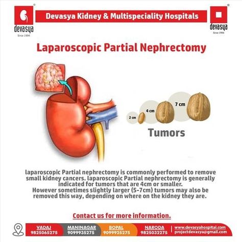 laparoscopic Partial nephrectomy is generally indicated for tumors that are 4cm or smaller. However sometimes slightly larger (5-7cm) tumors may also be removed this way, depending on where on the kidney they are. contact Devasya Kidney & Multispeciality Hospitalsfor more information. #kidney #kidneydisease #kidneytransplant #kidneyhealth #health #kidneyfailure #kidneystones #kidneys #dialysis #kidneycancer #kidneydonor #kidneywarrior #nephrology #ckd Kidney Donor, Back Stretches For Pain, Kidney Health, Health