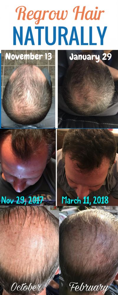 Regrow Hair Products - 7 Real Men Tell All With Before & After Pictures Regrow Hairline, Hair Growth Pills, Regrow Hair Naturally, Natural Hair Growth Remedies, Longer Hair Growth, How To Grow Natural Hair, Hair Growth Supplement, Home Remedies For Hair, Regrow Hair