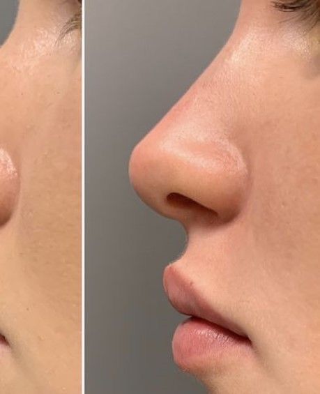 Nose Job Inspiration Straight, Defined Nose Bridge, Nose Job Natural, Nose Job Inspiration Natural Front View, Nose Job Inspiration Front View, Button Nose Aesthetic, Nose Job Inspiration Natural, Perfect Nose Front View, Nose Job Before And After