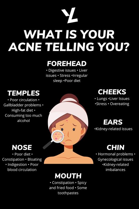 Heal Acne Fast, Where Acne Is And What It Means, What Does My Acne Mean, Acne Placement Meaning, Aesthetician School, Hormone Healing, Natural Remedies For Acne, Causes Of Acne, Different Types Of Acne