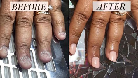 How This Manicurist Transformed Her Client’s Bitten Nails | Allure Bitten Nails, Fix Broken Nail, Manicure Pictures, Nails After Acrylics, Tropical Vacation Nails, Nail Problems, Ten Nails, Broken Nails, Nails Green