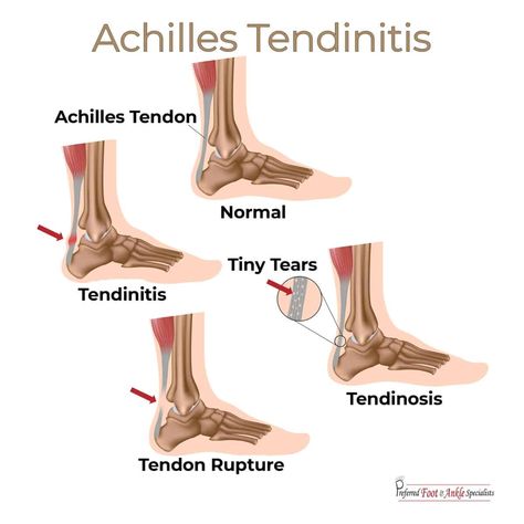 Achilles Tendon, Achilles Tendon Pain Relief, Massage Achilles Tendon, Achilles Tendon Stretches, Tight Achilles Tendon Stretches, Achilles Tendon Repair Recovery, Achilles Tendinopathy Exercises, Insertional Achilles Tendinopathy, Achilles Tendon Ruptures