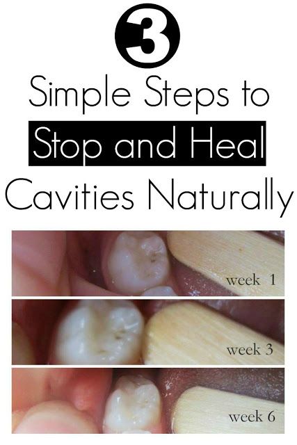 3 Simple Steps to Stop and Heal Cavities Naturally Heal Cavities Naturally, Home Remedies For Cavities, Cavity Remedy, Heal Cavities, Best Teeth Whitening, Oral Health Care, Homemade Remedies, Tooth Decay, Health Matters