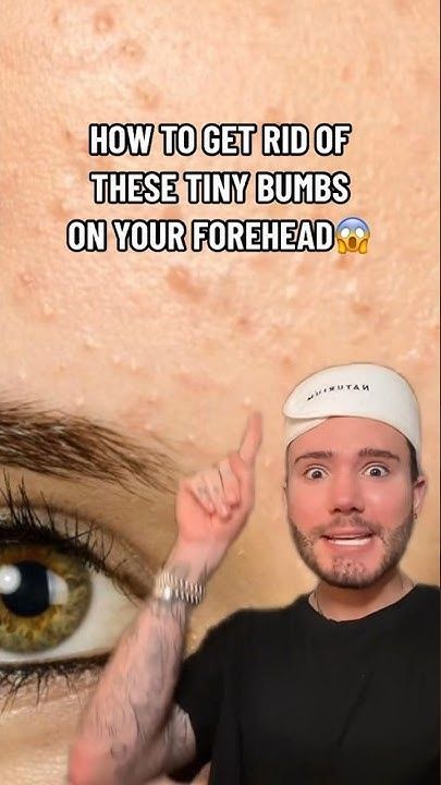 HOW TO GET RID OF FORHEAD BUMPS!😱(follow for more💗) #skincare #acne #skin #skincareroutine #beauty How To Take Care Of Pimples, Bumps On Face How To Get Rid Of, How To Get Rid Of A Cystic Pimple, How To Make Diy Pimple Patches, How To Get Rid Of Pimples Quick, How To Get Rid Of Unibrow, Why Do I Have Acne On My Forehead, Acne On Forehead Reasons For, How To Get Rid Of Big Pimples