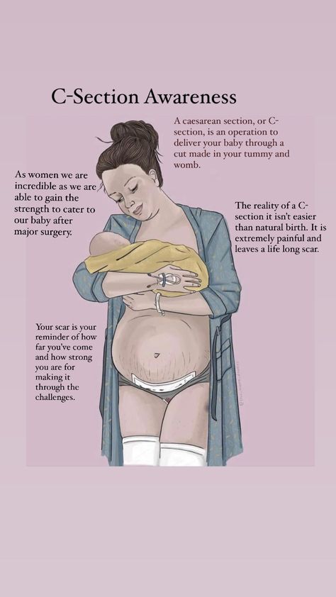 C Section Recovery Quotes, Cesarean Section Quotes, C Section Art, C Section Quotes Inspiration, C Section Awareness Month Quotes, C Section Affirmations, C Section Mom Quotes, Pregnancy Journey Quotes, Post Partum Quotes Mothers