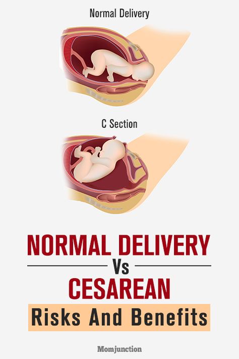 C-Section Vs. Normal Delivery: How Are They Different Normal Delivery Tips, Biological Facts, Medical Sutures, Bedding Master, Normal Birth, Birth Delivery, Cesarean Delivery, Birth Plan Template, Cesarean Section