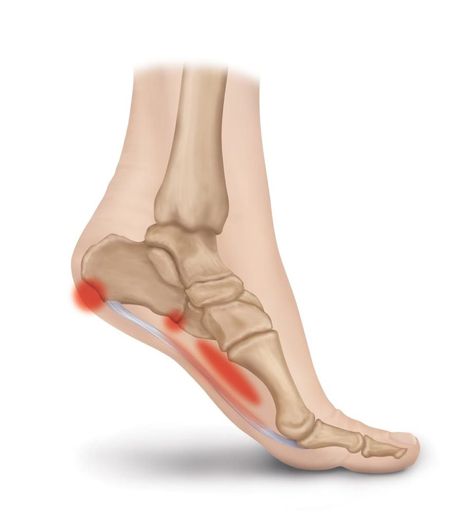 The Consequences of Leaving Plantar Fasciitis Untreated | Heel That Pain Sore Feet Remedies, Facitis Plantar, Headache Prevention, Fitness Shoes, Nerve Pain Relief, Hip Pain, Heel Pain, Nutrition Coach, Nerve Pain