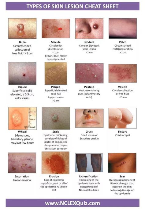 MEDizzy - Types of Skin Lesion Cheat Sheet Anatomy Revision, Nurses Notes, Wound Care Nursing, Skin Lesions, Medical Assisting, Nurse Practitioner School, Nursing Information, Nursing Assessment, Community Nursing