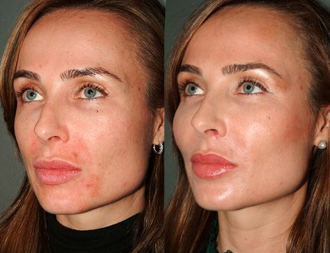 Mini Face Lifts Beverly Hills Mini Face Lift, Facelift Before And After, Face Lift Surgery, Face Lifting, Facial Plastic, Under Eyes, Before After Photo, Cosmetic Procedures, Mini Mini