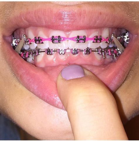 orthodontics dental braces Aesthetic Teeth, Power Chain Braces, Dental Braces Colors, Invisible Teeth Braces, Pink Braces, Braces Retainer, Braces And Glasses, Braces Smile, Cute Braces Colors