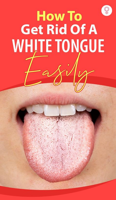 White Tongue Remedy, Sore Tongue Remedy, Mouth Sore Remedy How To Get Rid, Dry Mouth Remedies How To Get Rid, Dry Mouth Remedies, Cracked Tongue, Clean Tongue, Get Rid Of Candida, Remedies For Dry Mouth