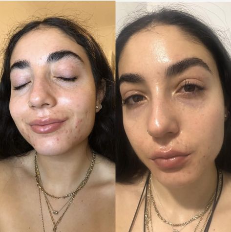 How to Keep Acne Skin Hydrated on Accutane Before And After Accutane, Accutane Survival Products, Acutane Before After, Accutane Skin Care, Accutane Tips, Accutane Survival, Accutane Before And After, Mild Acne, Spf Skincare