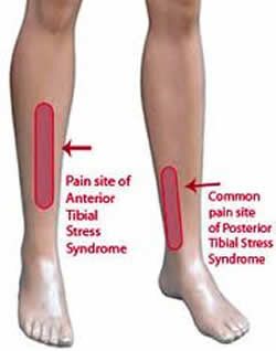 How To Use A Foam Roller For Shin Splints Shin Splints Stretches, Lower Leg Pain, Shin Splint Exercises, Small Wave Tattoo, Runner Problems, Running Injuries, Knee Exercises, Shin Splints, Leg Pain