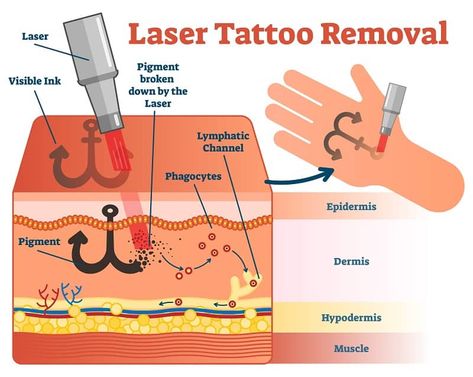 Wavelengths, pulses, and energy of laser tattoo removal At Home Tattoo Removal, Omerta Tattoo, Web Tattoo, Laser Removal, Magic Tattoo, Incredible Tattoos, Laser Tattoo, Laser Tattoo Removal, Pen Accessories