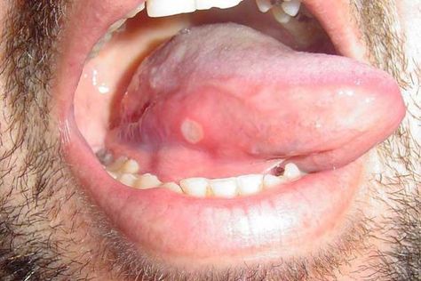 15 Common Tongue Diseases That Can Affect You Tongue Ulcer Remedies, Sore On Tongue Remedy, Blister On Tongue, Canker Sore On Tongue, Throat Ulcers, Ulcer On Tongue, Tongue Problems, Mouth Blisters, Ulcer Remedies Mouth