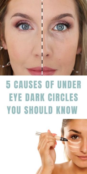 5 Causes of Under Eye Dark Circles You Should Know PLUS A Quick Concealer Hack How To Prevent Dark Circles Under Eyes, Purple Under Eye Circles, Cover Up Dark Circles Under Eyes, Dark Rings Under Eyes, Dark Circle Concealer, Under Eye Hollows, Under Eye Dark Circles, Dark Under Eye Circles, Eye Dark Circles