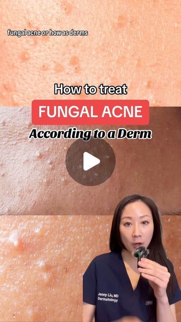 Jenny Liu, MD FAAD , Skincare expert on Instagram: "Tips for managing “fungal acne”:

Start with an anti-dandruff shampoo, use like a cleanser/body wash, leave on for few minutes then rinse off. Topical otc anti fungal creams may also be benefits 

However often the pityrosporum yeast is deeper in the hair follicles and require a course of oral medication for best response 

Drop any questions you have below 

#pityrosporumfolliculitis #fungalacne #acnecommunity #acnetips #dermatologist" What Is Fungal Acne, Nizoral For Fungal Acne, Dandruff Shampoo For Acne, Fungal Acne Skin Care Routine, Best Cream For Acne, Cream For Acne, Acne Routine, Antifungal Cream, Fungal Acne