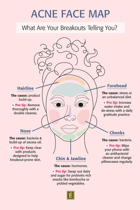 Acne Face Map, Face Map, Face Mapping Acne, Forehead Acne, Eminence Organic Skin Care, Skin Advice, Skin Care Routine Order, Face Mapping, Acne Face