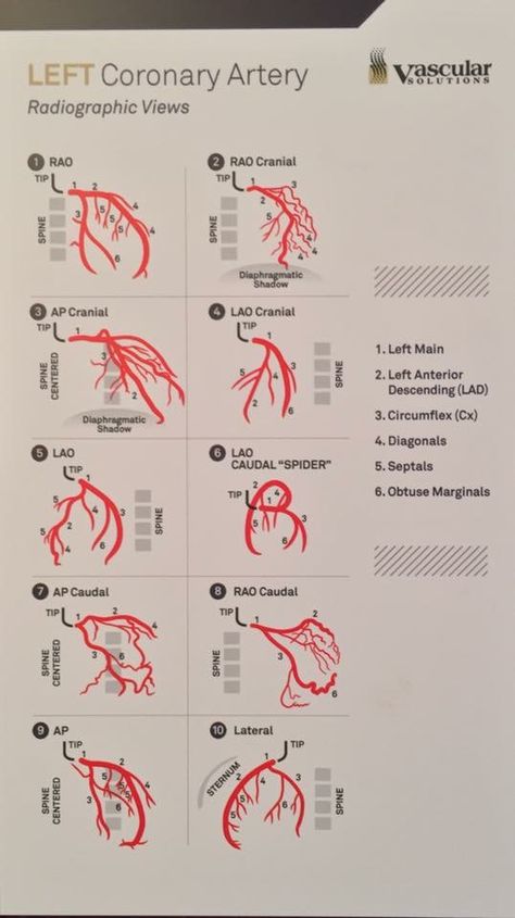 Left Coronary RAD view Coronaries Of Heart, Coronary Angiography Views, Coronary Angiography, Cath Lab Nursing, Cath Lab Nurse, Heart Catheterization, Cardiac Anatomy, Cardiac Sonography, Coronary Artery