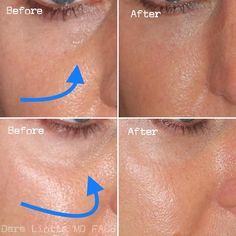 Trough Filler Before After, How To Get Rid Of Tear Troughs, Eye Trough Filler, Undereye Fillers Before And After, Tear Through Eye Filler, Tear Trough Remedy Natural, Tear Through Filler Before And After, Prp Undereye Before And After, Eye Trough Filler Before And After