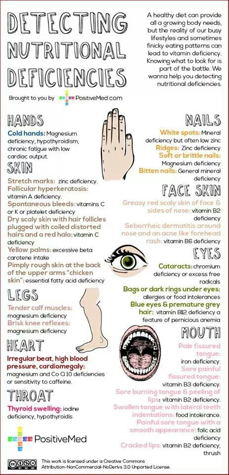 Detecting Vitamin/Nutrient defencies by symptoms Chart Nutrition Sportive, Nutritional Deficiencies, Health Info, Health Remedies, Body Health, Healthy Tips, Holistic Health, Healthy Body, Health And Nutrition