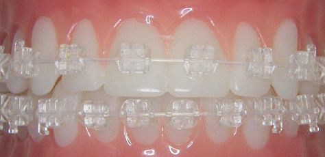 Now this is a cool looking esthetic wire! Simpliclear.com has them. Ceramic Braces, Cute Braces Colors, Adult Braces, Cute Braces, Clear Braces, Brace Face, Orthodontics Braces, Braces Colors, Dental Braces