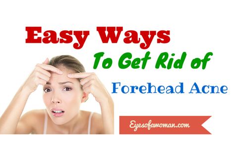 How to get rid of forehead acne, how to get rid of forehead acne overnight, how to get rid of forehead acne in 2 days, how to get rid of forehead wrinkles, forehead pimples reason for pimples on forehead, do bangs cause acne, how to get rid of acne bumps, how to get rid of pimples on forehead Reasons For Pimples, Forehead Pimples, Get Rid Of Forehead Acne, Get Rid Of Forehead Wrinkles, Pimples On Forehead, Forehead Acne, Get Rid Of Pimples, Rid Of Pimples, Acne Overnight