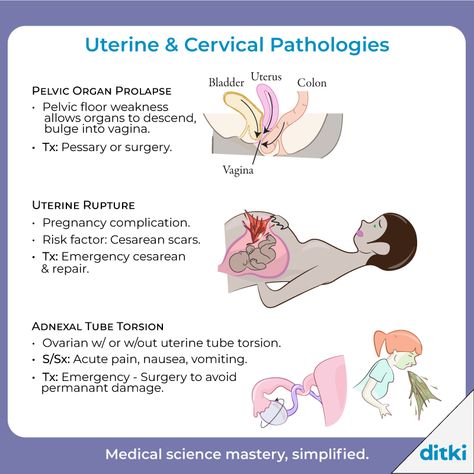 A glimpse of our Uterine & Cervical Pathologies tutorial - see more: https://ditki.com/course/pathology/reproductive-pathologies/uterine-ovarian-pathologies/2024/cervical-uterine-pathologies---nonneoplasms   #ditki #usmle #meded #medschool #medstudent #highered #mededonline #usmletutorials #nursepractitioner #nursing #pance #physicianassistant #osteopath #allopath #medicine #science #healthscience #nurse #premed #mcat #mbbs Clinical Pathology, Uterine Polyps, Urinary Bladder, Pelvic Muscles, Cesarean Delivery, Medical Study, Lymph Vessels, Pelvic Organ Prolapse, Family Nurse Practitioner