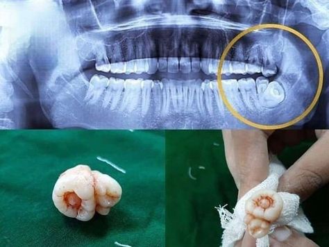 Impacted wisdom teeth with concrescence Impacted Wisdom Teeth, Dental Student, Dhaka Bangladesh, Wisdom Teeth, Together Forever, Oral Health, Hi There, True Love, Health