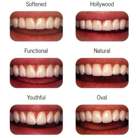 Cosmetic Dentistry - Los Angeles Cosmetic Dentistry - Culver City Cosmetic Dentistry - Centurysmile.com Teeth Makeover, Dental Makeover, Cosmetic Dentistry Veneers, Cosmetic Dentistry Procedures, Dental Aesthetics, Teeth Whitening Homemade, Veneers Teeth, Beautiful Teeth, Perfect Teeth