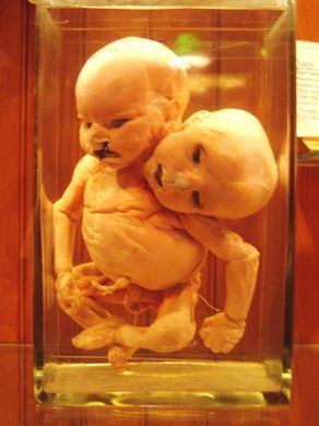 The Mutter Museum contains many medical oddities. Human Oddities, Creepy Photos, Evil Clowns, Weird Science, Medical History, Weird And Wonderful, Documentaries, The Internet, Oeuvre D'art