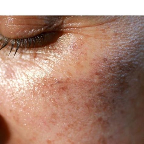 Christine Lindsay on Instagram: "What is photoaging and how can you reverse it? Photoaging is the same as sun damage or premature aging. It occurs when you expose your skin to the sun’s UV rays without protection. This damages the collagen (protein) and DNA in your skin cells and makes your skin age faster! You can easily prevent photoaging by protecting your skin with high-quality sun care products. Top Products for Preventing Photoaging: • Hydrating Protection Gel SPF 30 • Moisturizing Pro After Sun, Protect Skin From Sun, Facial Aesthetics, Sun Damaged Skin, Collagen Protein, Sun Damage, Sun Care, Aging Process, Essential Oil Recipes