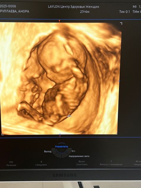 3d Ultrasound, Cute Pregnancy Pictures, Pregnancy Pictures, 16 Weeks, Ultrasound, Maternity Pictures