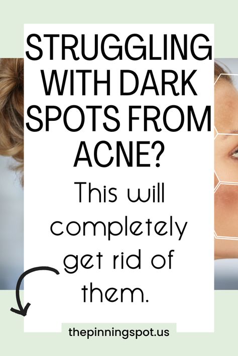 Looking for a solution to dark spots from acne? Dive into our blog post to uncover effective treatments and remedies. From creams to overnight solutions, we've curated the best methods to fade dark spots and marks away to reveal brighter, clearer skin. Say goodbye to uneven skin tone & hello to confidence with our expert tips and recommendations.  Dive into our blog post to uncover the secrets to eliminating dark spots caused by acne. Say goodbye to blemishes & dark spots on your face from acne How To Lighten Acne Marks, Lighten Dark Spots On Face, Get Rid Of Acne Marks Dark Spots, Baking Soda Face Mask Dark Spots, Acne Dark Spots Remedies, How To Get Rid Of Scars From Acne, Dark Spots On Face Remedies, Fade Dark Spots On Face, Dark Skin Spots