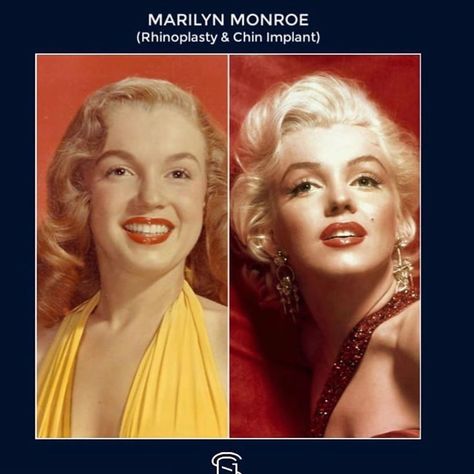 Jessica Manges ARNP Aesthetic on Instagram: “Marilyn Monroe had a rhinoplasty and chin implant which gave her the iconic look we remember her today by. Beauty icons throughout history…” Marilyn Monroe Nose Job, Chin Implant Before And After, Chin Implant, Facial Plastic Surgery, Facial Aesthetics, Celebrity Plastic Surgery, Reconstructive Surgery, Facial Plastic, Norma Jean