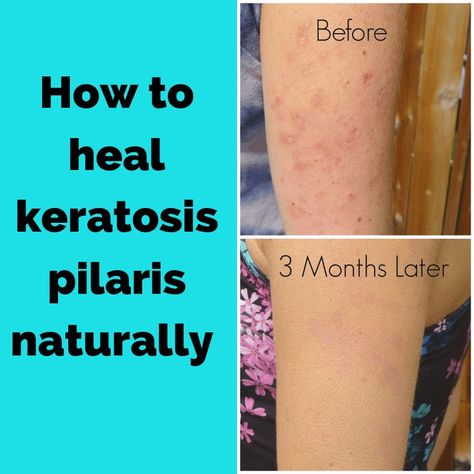 Chicken Skin Remedy, Arm Acne, Keratosis Pilaris Remedy, Keratosis Pilaris Treatment, I Healed, Strawberry Legs, Skin Bumps, Facial Products, Keratosis Pilaris