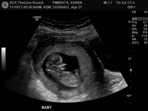 Baby boy ultrasound 3 Month Ultrasound, Boy Ultrasound, Fake Ultrasound, Baby Ultrasound Pictures, Pregnancy Ultrasound, Baby Ultrasound, Ultrasound Pictures, Career Planning, 2nd Baby