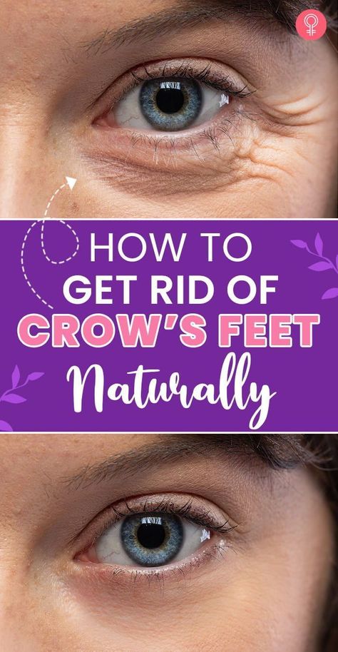 Best Eye Wrinkle Cream Crows Feet Anti Aging, How To Get Rid Of Crows Feet Eye, Crows Feet Remedies, Eye Wrinkles Get Rid Of, Crows Feet Wrinkles How To Get Rid, Facial Remedies, Crows Feet Wrinkles, Home Remedies For Wrinkles, Face Treatments