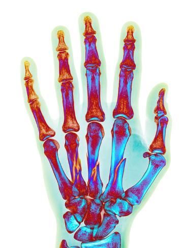 size: 16x12in Photographic Print: Fractured Palm Bones of Hand, X-ray by Science Photo Library : Entertainment Carpal Bones, 35 Year Old Man, Xray Art, Library Posters, Bio Art, Science Photos, Pahlawan Super, Arte Horror, Anatomy Art