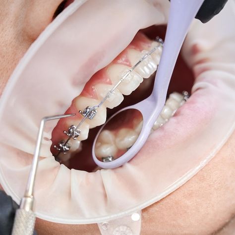 Composite Bonding, Ceramic Braces, Dental Photos, Dental Photography, Metal Braces, Dental Center, Family Dentistry, Natural Teeth Whitening, Best Dentist