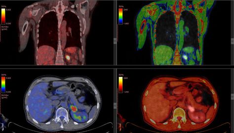 Understanding Your FDG PET Scan Pet Ct, Pet Scan, Ig Aesthetic, Nuclear Medicine, Ct Scan, Medical Imaging, Cellular Level, Best Doctors, Radiology