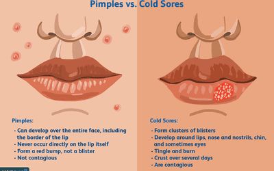 How to Heal a Popped Pimple Scab Pimples On Lip Line, Cold Sore Scab, Cold Sore Stages, Blister On Lip, Lip Pimple, Pimple Causes, Cystic Pimple, Fever Blister, Cold Sores