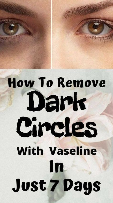 Dark Circle Remedies, Dark Circles Around Eyes, Dark Eye Circles, Skin Care Wrinkles, Dark Circles Under Eyes, Dark Under Eye, Remove Dark Circles, Eye Circles, Les Rides