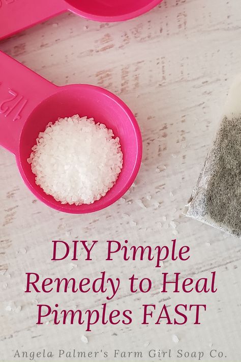 Zit Remedy, Natural Remedies For Pimples, Painful Pimple, Redness Pimple, Dry Out Pimples, Big Pimple, Pimple Cream, Blind Pimple, Home Remedies For Pimples