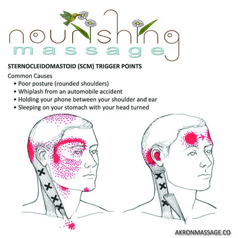 Sternocleidomastoid Trigger Point Release and Stretch - Nourishing Massage Temporal Bone, Trigger Point Release, Referred Pain, Trigger Point, Trigger Points, Poor Posture, Whiplash, The More You Know, Massage